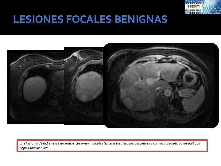 LESIONES FOCALES BENIGNAS En el estudio de RM en fase arterial se observan múltiples
