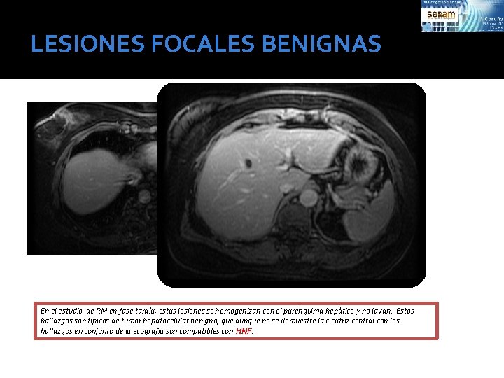 LESIONES FOCALES BENIGNAS En el estudio de RM en fase tardía, estas lesiones se