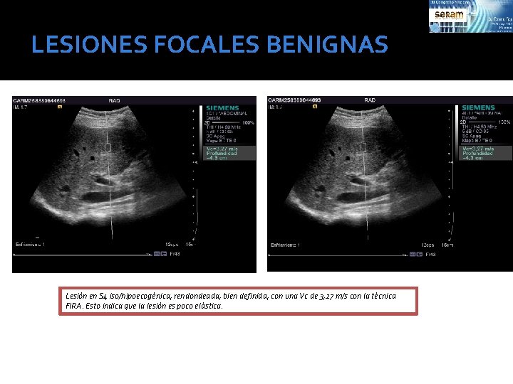 LESIONES FOCALES BENIGNAS Lesión en S 4 iso/hipoecogénica, rendondeada, bien definida, con una Vc