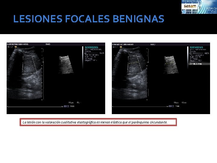 LESIONES FOCALES BENIGNAS La lesión con la valoración cualitativa elastográfica es menos elástica que