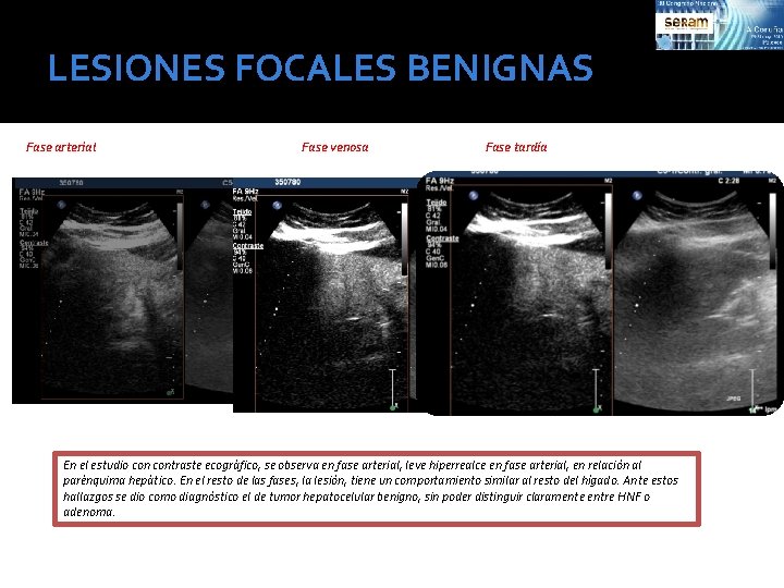 LESIONES FOCALES BENIGNAS Fase arterial Fase venosa Fase tardía En el estudio contraste ecográfico,