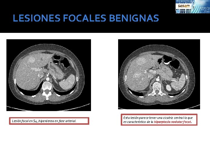 LESIONES FOCALES BENIGNAS Lesión focal en S 4 , hiperdensa en fase arterial. Esta