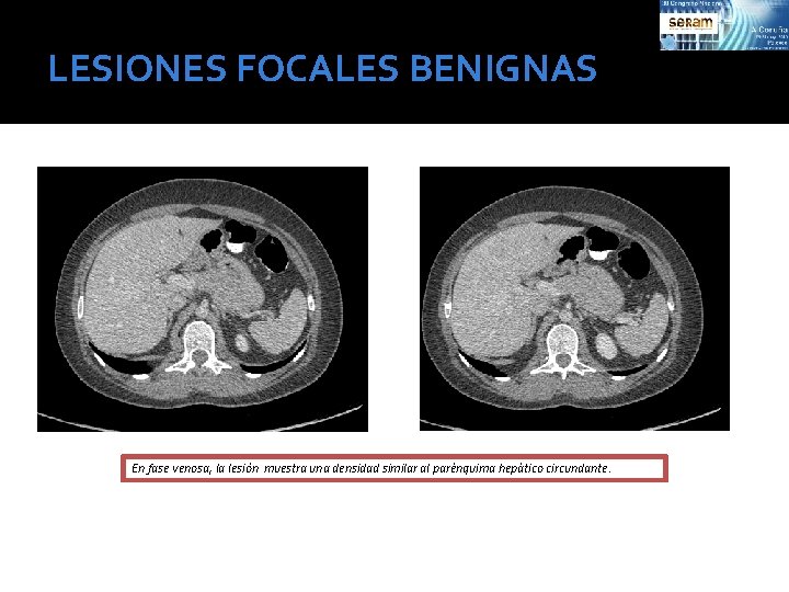 LESIONES FOCALES BENIGNAS En fase venosa, la lesión muestra una densidad similar al parénquima
