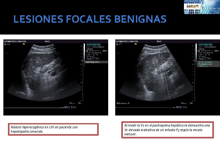 LESIONES FOCALES BENIGNAS Nódulo hiperecogénico en LHI en paciente con hepatopatía conocida. Al medir