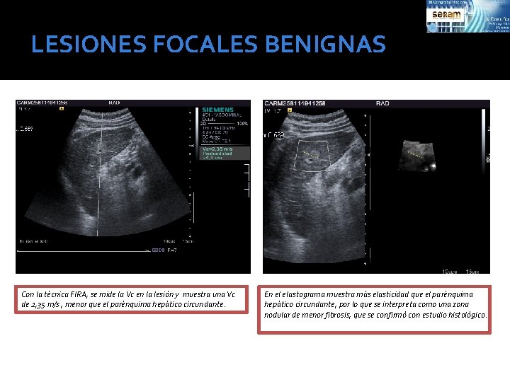 LESIONES FOCALES BENIGNAS Con la técnica FIRA, se mide la Vc en la lesión