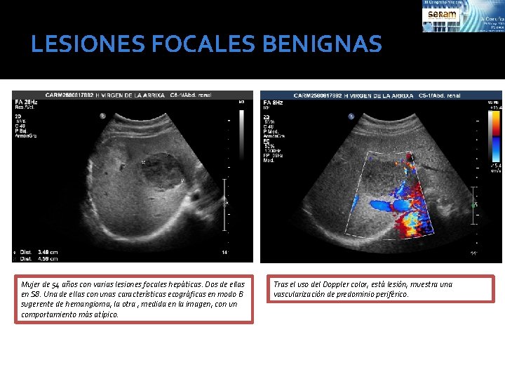 LESIONES FOCALES BENIGNAS Mujer de 54 años con varias lesiones focales hepáticas. Dos de