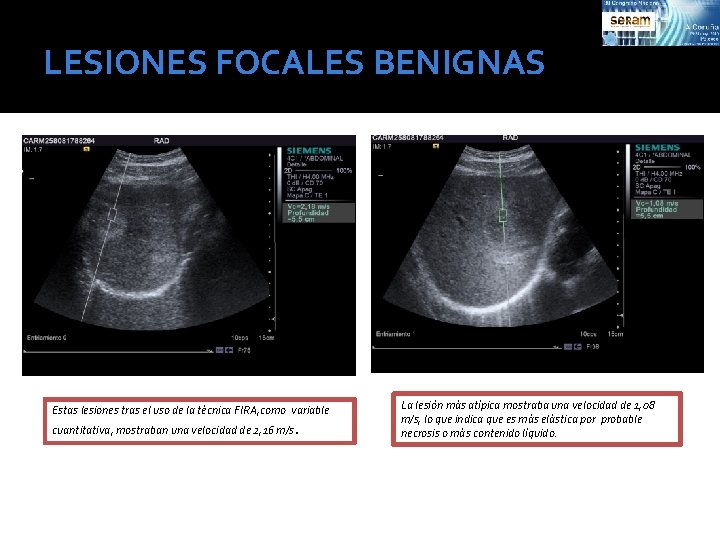 LESIONES FOCALES BENIGNAS Estas lesiones tras el uso de la técnica FIRA, como variable