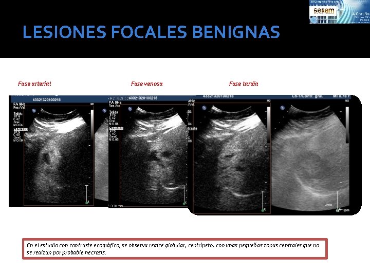 LESIONES FOCALES BENIGNAS Fase arterial Fase venosa Fase tardía En el estudio contraste ecográfico,