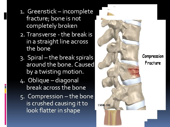 1. Greenstick – incomplete fracture; bone is not completely broken 2. Transverse - the 1. Greenstick – incomplete fracture; bone is not completely broken 2. Transverse - the