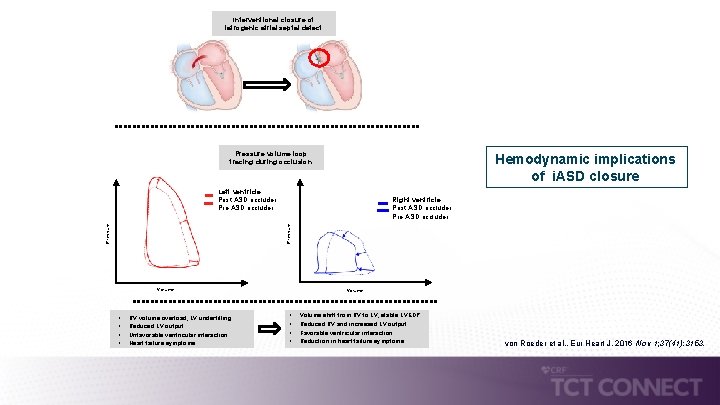 Interventional closure of iatrogenic atrial septal defect Pressure volume loop tracing during occlusion Hemodynamic