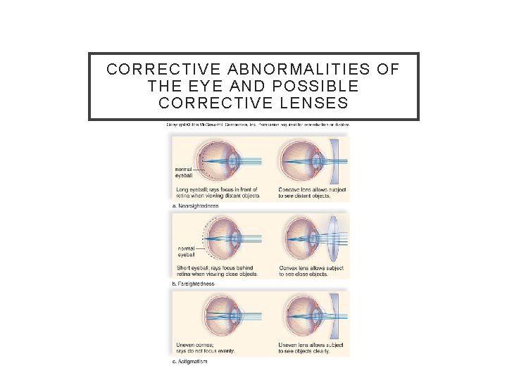 CORRECTIVE ABNORMALITIES OF THE EYE AND POSSIBLE CORRECTIVE LENSES 