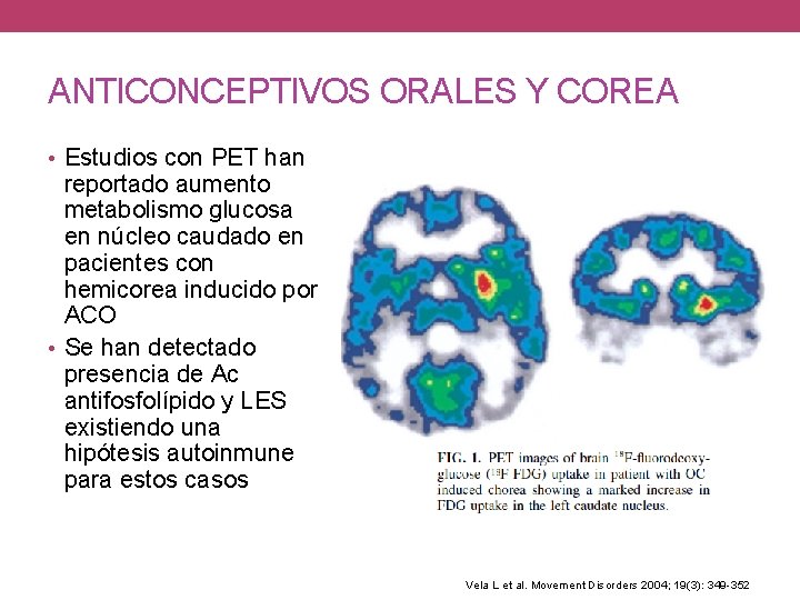 ANTICONCEPTIVOS ORALES Y COREA • Estudios con PET han reportado aumento metabolismo glucosa en