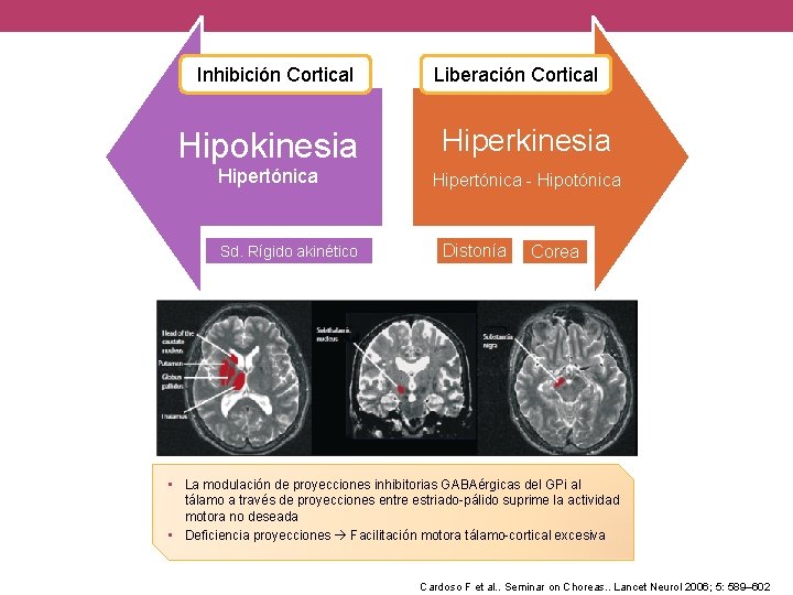 Inhibición Cortical Hipokinesia Hipertónica Sd. Rígido akinético Liberación Cortical Hiperkinesia Hipertónica - Hipotónica Distonía