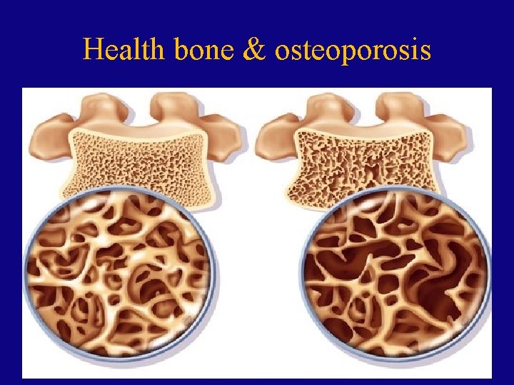 Health bone & osteoporosis 22 