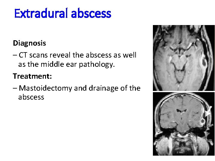 Extradural abscess Diagnosis – CT scans reveal the abscess as well as the middle