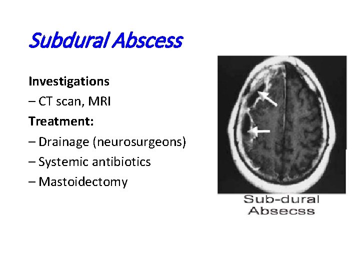 Subdural Abscess Investigations – CT scan, MRI Treatment: – Drainage (neurosurgeons) – Systemic antibiotics