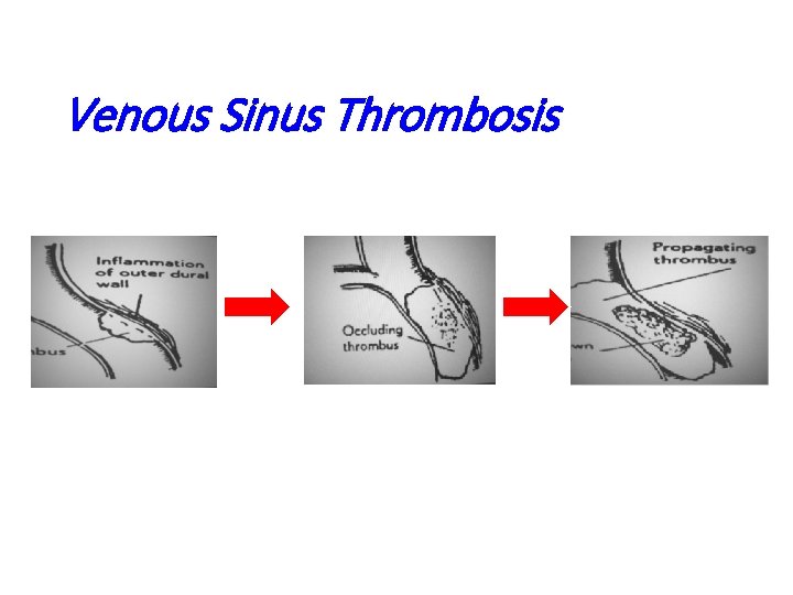 Venous Sinus Thrombosis 