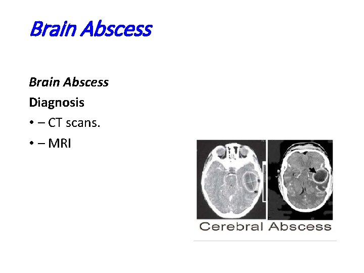 Brain Abscess Diagnosis • – CT scans. • – MRI 