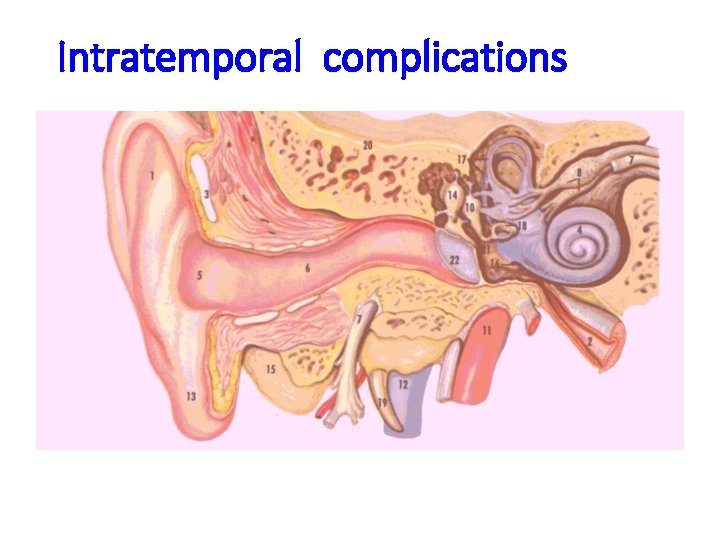 Intratemporal complications 