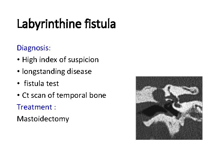 Labyrinthine fistula Diagnosis: • High index of suspicion • longstanding disease • fistula test