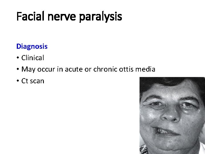 Facial nerve paralysis Diagnosis • Clinical • May occur in acute or chronic ottis