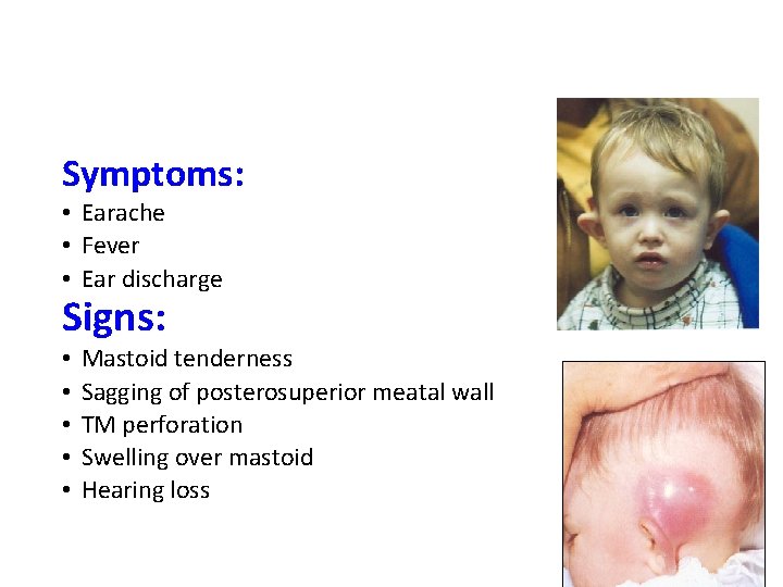 Symptoms: • Earache • Fever • Ear discharge Signs: • • • Mastoid tenderness