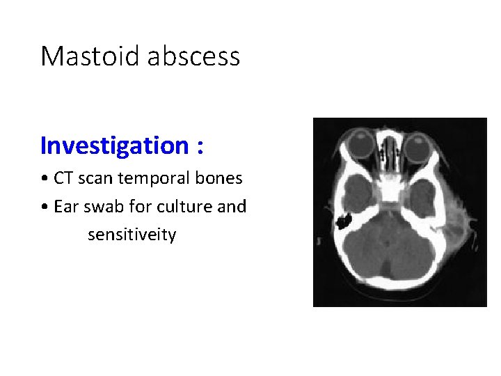 Mastoid abscess Investigation : • CT scan temporal bones • Ear swab for culture