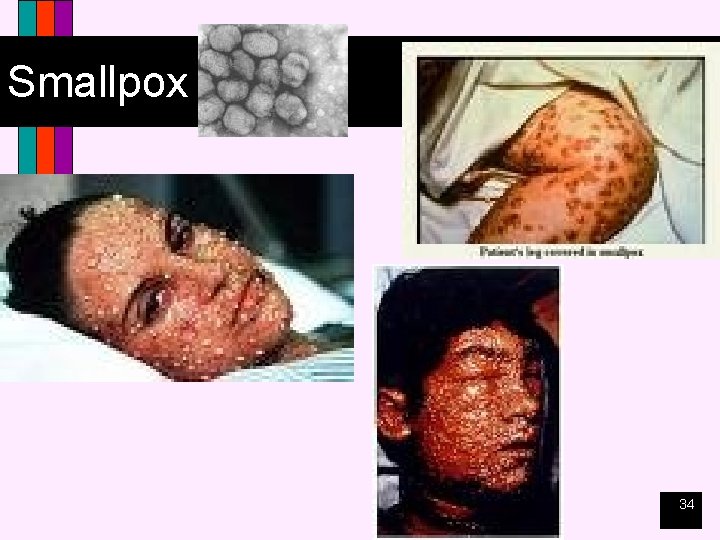 Smallpox 34 