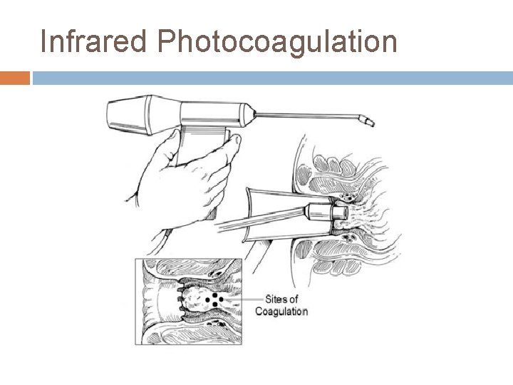 Infrared Photocoagulation 