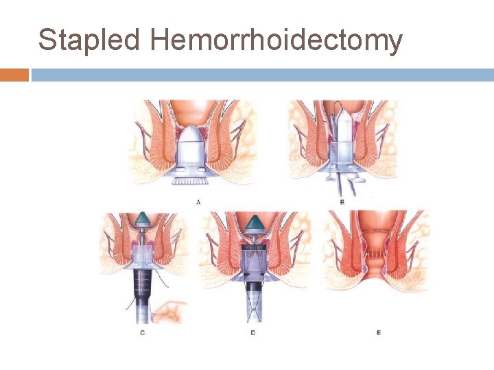 Stapled Hemorrhoidectomy 