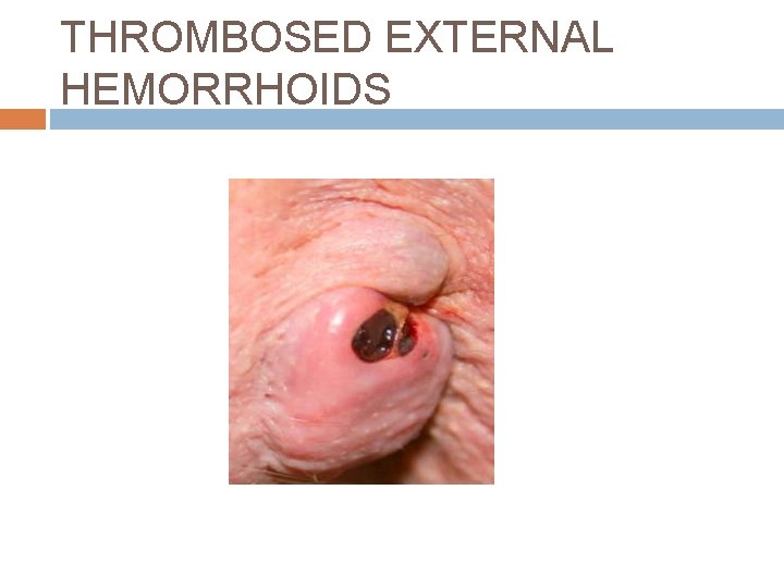 THROMBOSED EXTERNAL HEMORRHOIDS 