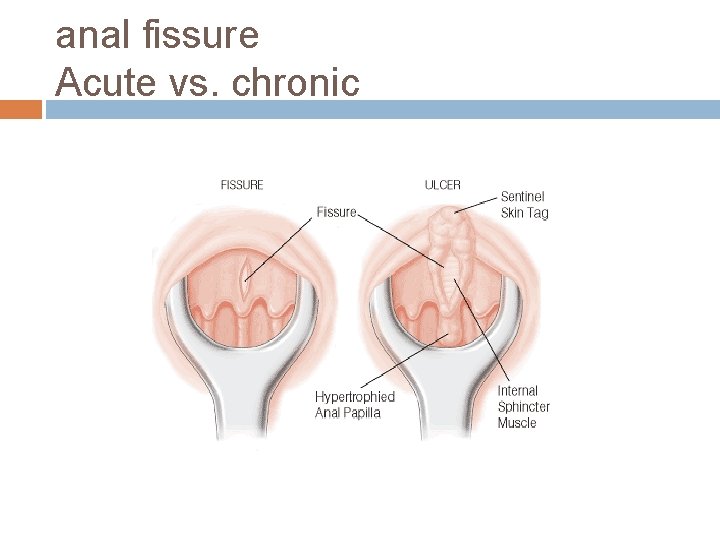 anal fissure Acute vs. chronic 