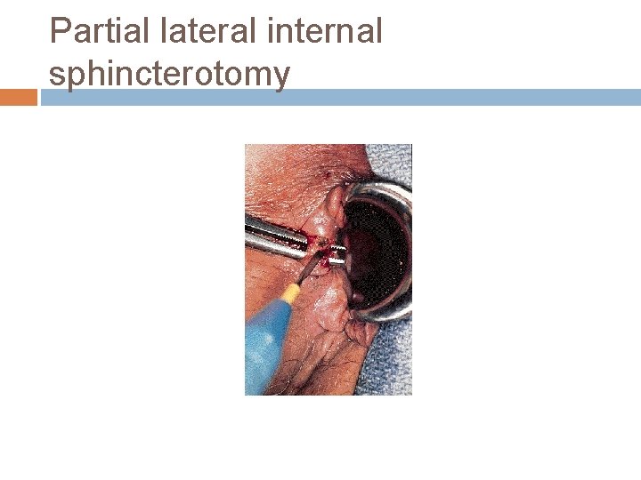 Partial lateral internal sphincterotomy 