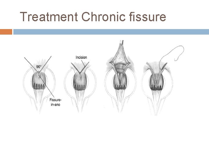 Treatment Chronic fissure 