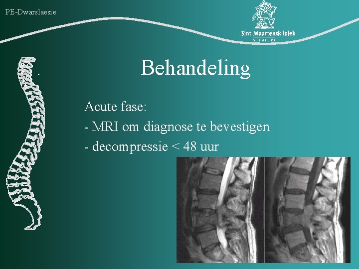 PE-Dwarslaesie Behandeling Acute fase: - MRI om diagnose te bevestigen - decompressie < 48