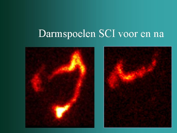 Darmspoelen SCI voor en na 