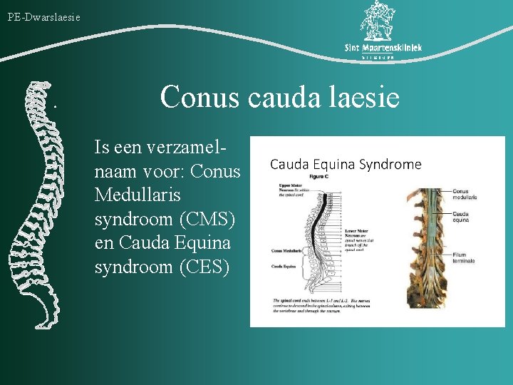 PE-Dwarslaesie Conus cauda laesie Is een verzamelnaam voor: Conus Medullaris syndroom (CMS) en Cauda