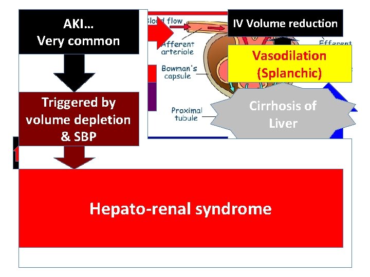 Renal AKI… hypoperfusion IV Volume reduction Very common Vasodilation (Splanchic) Vasodilation AG II PG