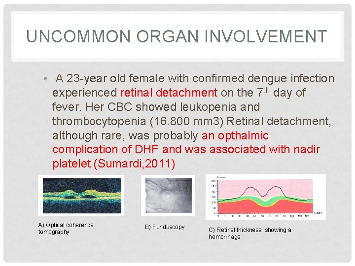 UNCOMMON ORGAN INVOLVEMENT • A 23 -year old female with confirmed dengue infection experienced