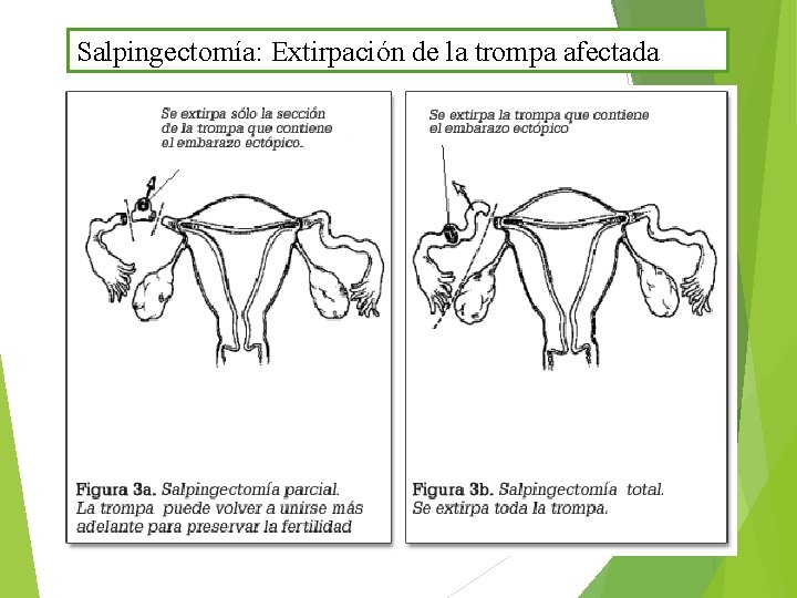 Salpingectomía: Extirpación de la trompa afectada 