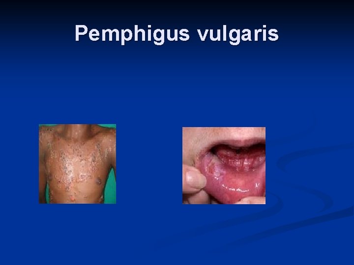 Pemphigus vulgaris 