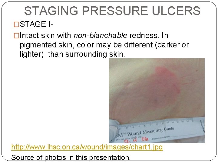 STAGING PRESSURE ULCERS �STAGE I�Intact skin with non-blanchable redness. In pigmented skin, color may