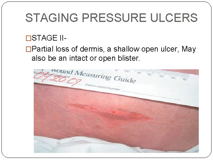 STAGING PRESSURE ULCERS �STAGE II�Partial loss of dermis, a shallow open ulcer, May also