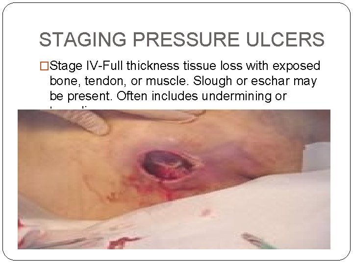 STAGING PRESSURE ULCERS �Stage IV-Full thickness tissue loss with exposed bone, tendon, or muscle.