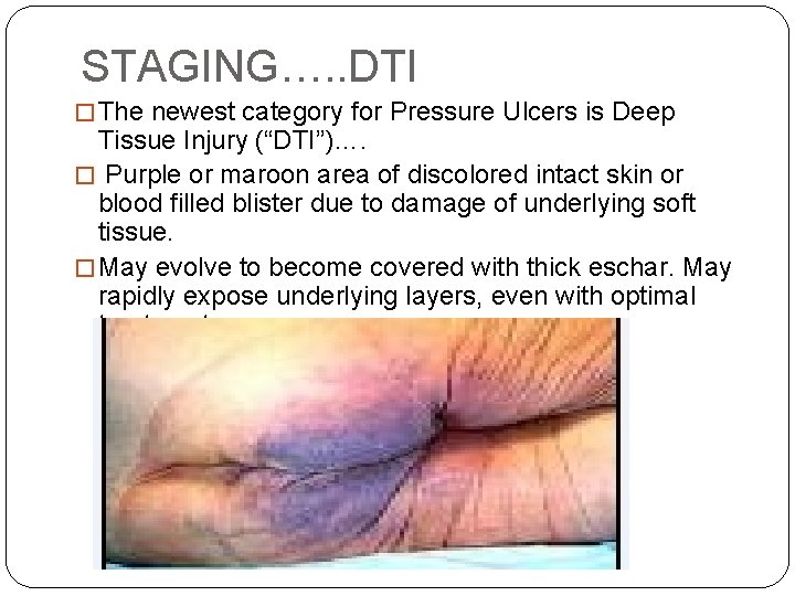 STAGING…. . DTI � The newest category for Pressure Ulcers is Deep Tissue Injury