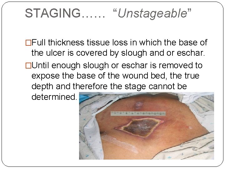 STAGING…… “Unstageable” �Full thickness tissue loss in which the base of the ulcer is