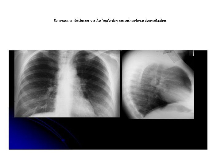 Se muestra nódulos en vertice izquierdo y ensanchamiento de mediastino. 