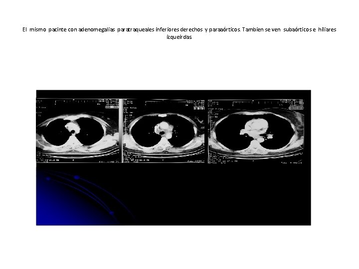 El mismo pacinte con adenomegalias paratraqueales inferiores derechos y paraaórticos. Tambien se ven subaórticos