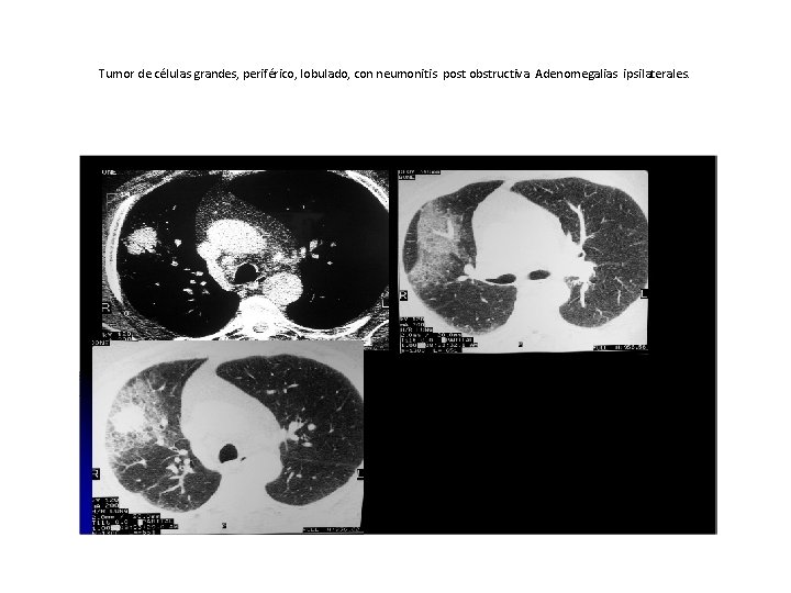 Tumor de células grandes, periférico, lobulado, con neumonitis post obstructiva. Adenomegalias ipsilaterales. 