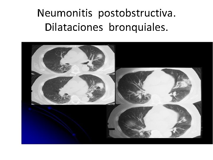Neumonitis postobstructiva. Dilataciones bronquiales. 